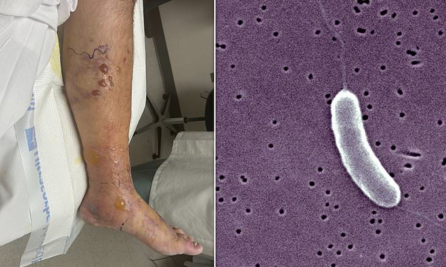 Flesh eating-bacteria claims another victim as officials warn public